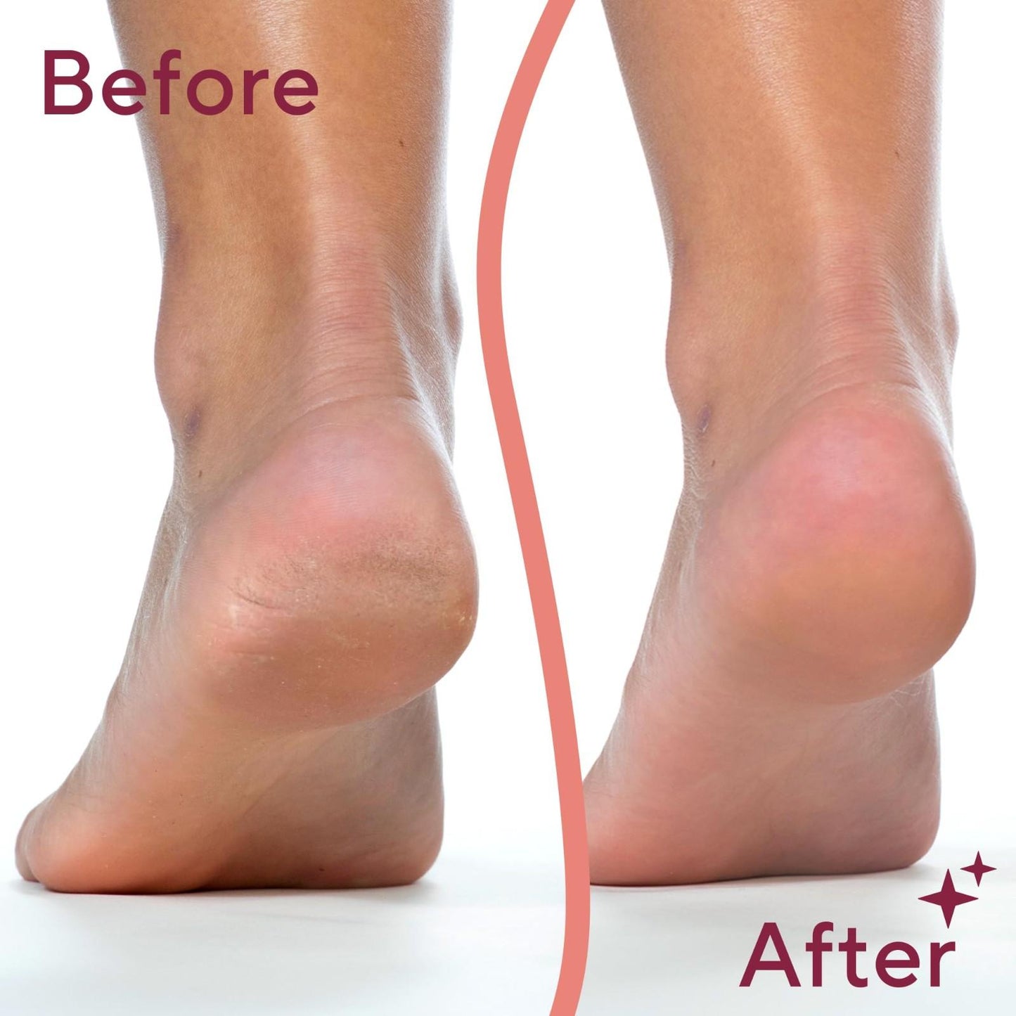 Electric Foot Callus Remover – Get Soft & Smooth Feet At Home