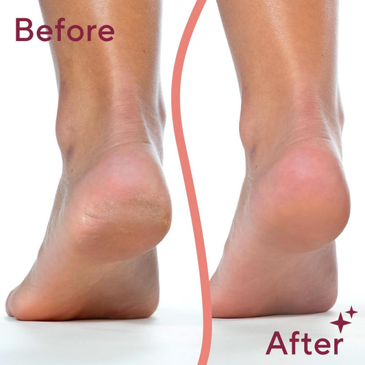 Electric Foot Callus Remover – Get Soft & Smooth Feet At Home